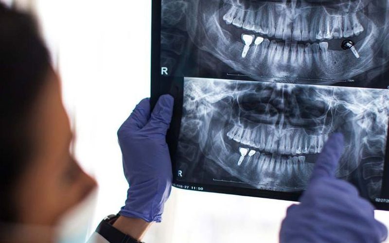 Full mouth implants package