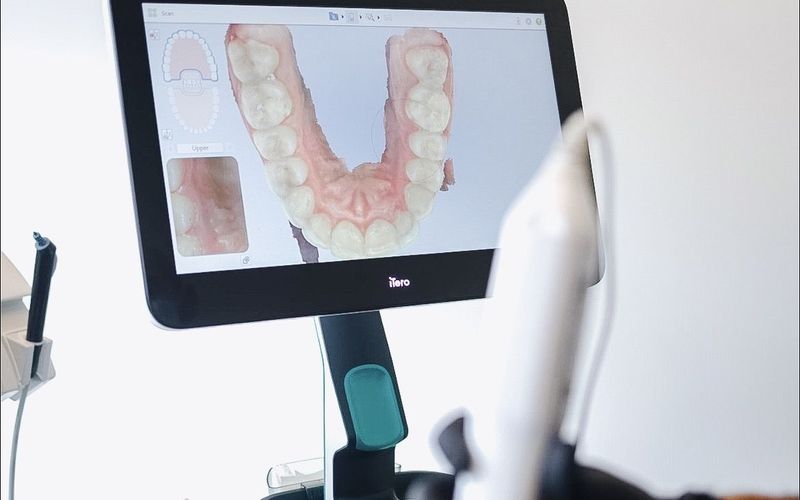 Invisalign package with iTero 3D scan