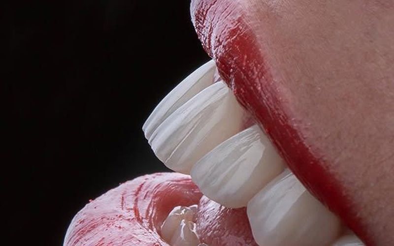 Smile makeover veneers package