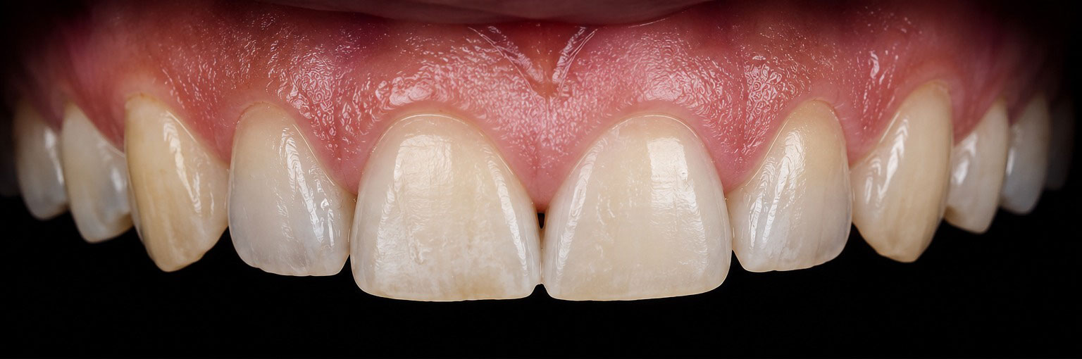 Before — Hollywood smile veneer treatment