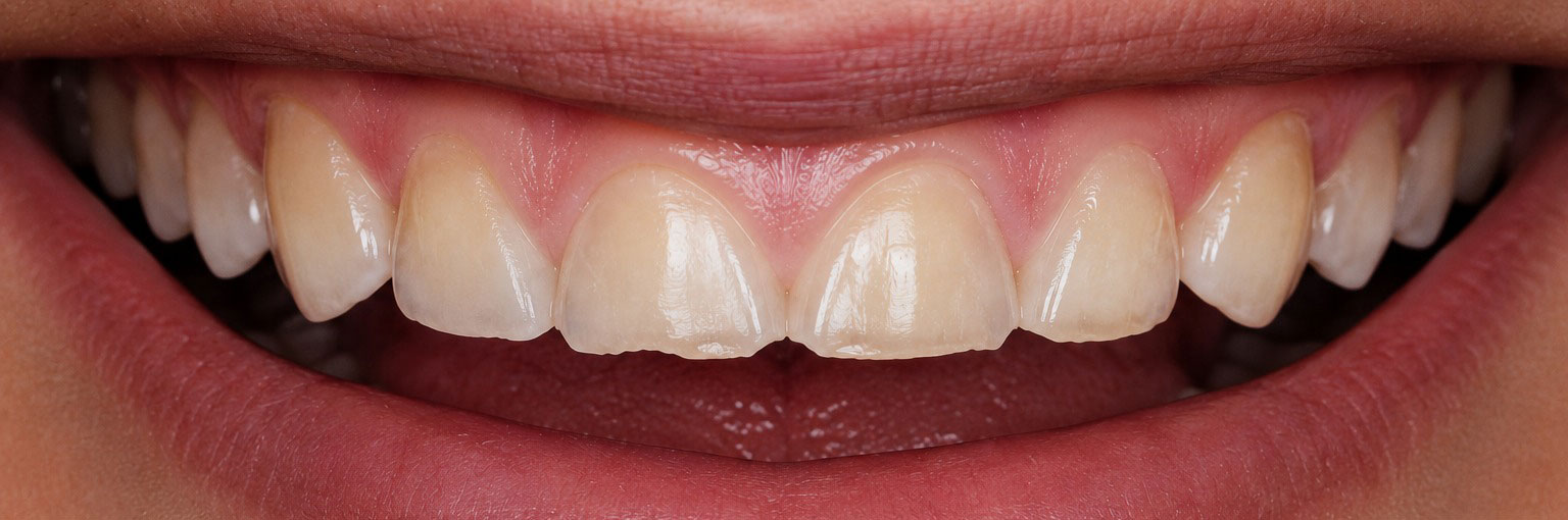 Before — worn down front teeth