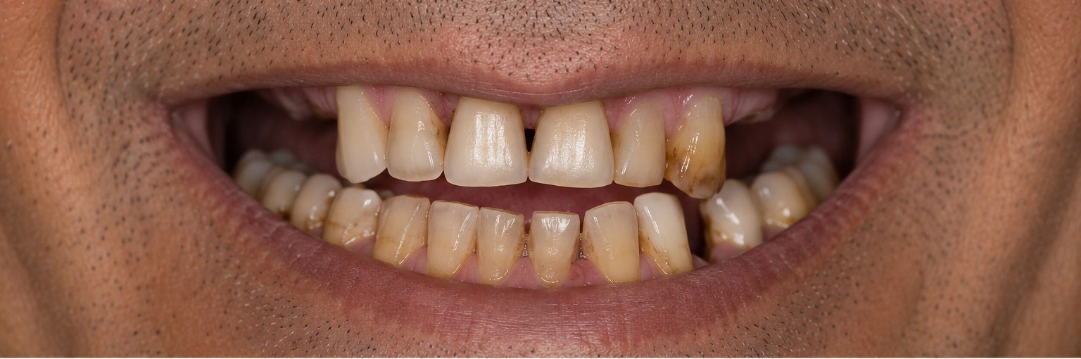 Before — extensive dental issues requiring full mouth rehabilitation