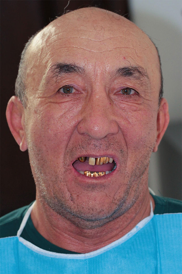 Before Invisalign treatment — misaligned teeth