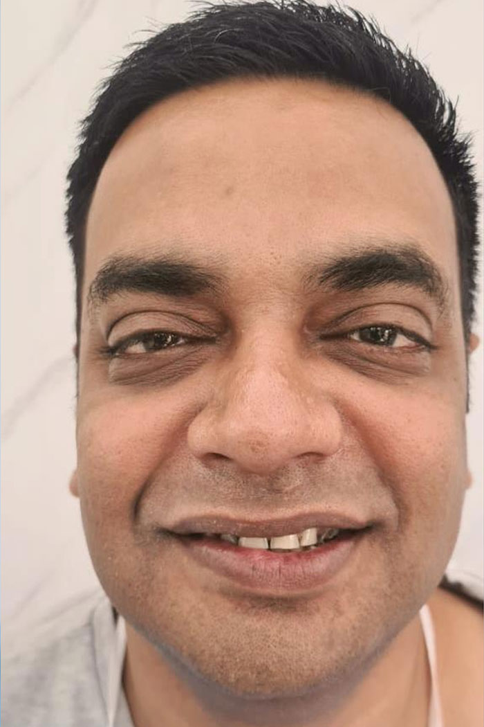 Before porcelain veneers